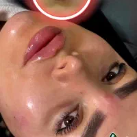 تزریق ژل و بوتاکس کلیه خدمات زیبایی(کلینیک ایرانا)