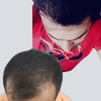 تکنسین تهرانی کاشت مو و کاشت ابرو در کرمانشاه