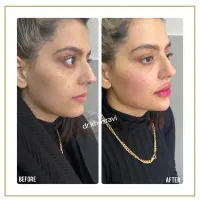 آف ویژه تزریق ژل و بوتاکس|خدمات آرایشگری و زیبایی|یاسوج, |دیوار