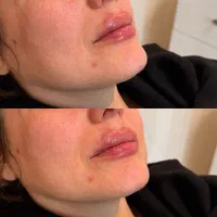 اسپارتینا بوتاکس ژل فیلر چربی مزوژل نخ لیف