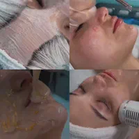 فیشیال تخصصی،مزونیدلینگ