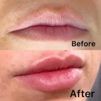 ژل وبوتاکس ومزونیدلینگ وحجامت|خدمات آرایشگری و زیبایی|فولادشهر, B2|دیوار