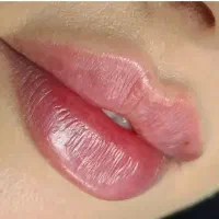 ژل و بوتاکس