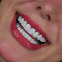 ایمپلنت کامپوزیت ارتودنسی روکش لمینت|خدمات آرایشگری و زیبایی|ایلخچی, |دیوار