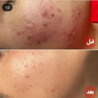 فرصتی استثنائی برای فیشال و درمان پوست شما|خدمات آرایشگری و زیبایی|تهران, خزانه|دیوار