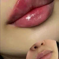 ژل وبوتاکس و گونه ومزو جوانسازی