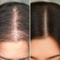پک مراقبت از مو وریزش مو