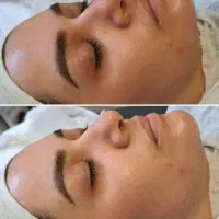 فیشیال و کربوکسی تراپی تخصصی پوست با تخفیفات ویژه|خدمات آرایشگری و زیبایی|قرچک, میرزائی شمالی|دیوار