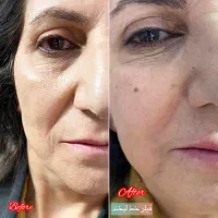 جشنواره تزریق ژل و بوتاکس (توسط پزشک)|خدمات آرایشگری و زیبایی|اصفهان, عباسآباد|دیوار