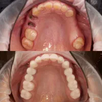 ایمپلنت تخصصی در ارومیه