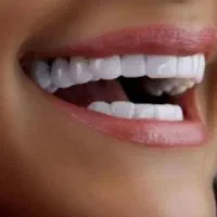 لمینت متحرک دندان