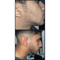 پرپشتی ریش بدون کاشت و خون ریزی|آرایشی، بهداشتی، درمانی|مرودشت, بیست متری بیمارستان|دیوار