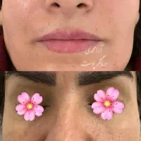 درمان پوست باتخفیف بلک فرایدی/پوست کره‌ای/کاموفلاژ