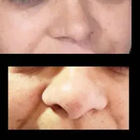 جشنواره ژل و بوتاکس تخصصی