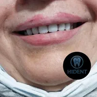 کارگاه تخصصی دندان‌ مصنوعی های‌دِنت معاینه رایگان|خدمات آرایشگری و زیبایی|گلستان (تهران), |دیوار