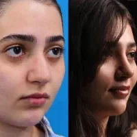 تخفیف 10 میلیونی عمل جراحی بینی