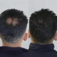 پرپشتی.کامل.ریش.و مو تضمینی