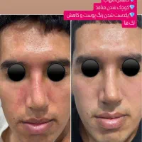روشن سازی با لیزر پیکوشور و پاک کردن تتو|خدمات آرایشگری و زیبایی|هندیجان, |دیوار