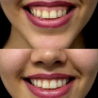 تزریق بوتاکس لبخند لثه ای