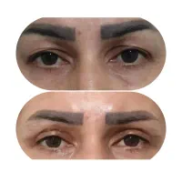 بلفاروپلاستی پلک با شرایط ویژه