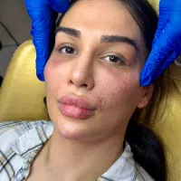 فیلر بینی ژل لب تکنیک M تخصصی تزریق فول فیس نچرال|خدمات زیبایی و سلامت|تهران, الهیه|دیوار