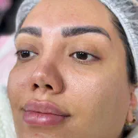 فیشال تخصصی زیر نظر پزشک|خدمات آرایشگری و زیبایی|مسجد سلیمان, |دیوار