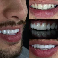 دندانپزشکی زیبایی در پونک