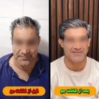 جشنواره یلدایی کاشت تخصصی مو و ابرو (شرایط اقساط)|خدمات آرایشگری و زیبایی|شیراز, خلدبرین|دیوار