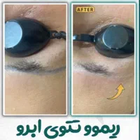 پاک کردن تتو ابرو و ریموو خالکوبی بدن توسط پزشک|خدمات آرایشگری و زیبایی|رشت, گلسار|دیوار