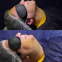 کانتورینگ لیفت فیلر بوتاکس مزو|خدمات آرایشگری و زیبایی|اصفهان, سپاهان‌شهر|دیوار