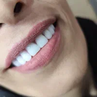 دندان مصنوعی طرح کامپوزیت و لمینت هر فک ۵ تومان