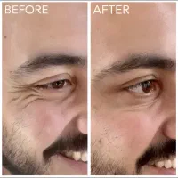 بوتاکس صورت و تعریق ۳نفر۹۸۰ توسط پزشک متخصص در مطب