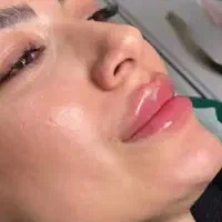 تزریق تخصصی فیلربوتاکس فیلربادی وانزیم|خدمات زیبایی و سلامت|تهران, جمهوری|دیوار