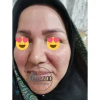 برداشتن خال و زگیل و کک مک و میخچه محلول تضمینی|خدمات آرایشگری و زیبایی|مشهد, شهرآرا|دیوار