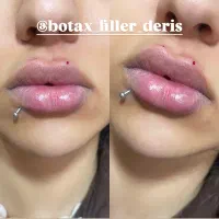 ژل و بوتاکس