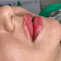 بوتاکس چشم گربه ای|خدمات آرایشگری و زیبایی|تهران, سازمان برنامه شمالی|دیوار