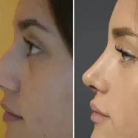 جراحی بینی/لیپو/مامولیفت(با تخفیفات جشنواره)