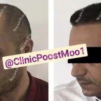 Iکاشت مو بدون جراحی بدون کوتاهی