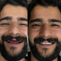 دندانسازی /دندان مصنوعی/ احمد آباد جی شرقی