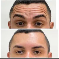 جشنواره ۵۰درصد تخفیف بوتاکس مخصوص خانم ها و آقایان|خدمات آرایشگری و زیبایی|دزفول, |دیوار