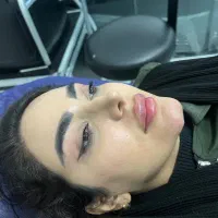 تخفیف بسیار ویژه فیلر صورت ۷۹۰