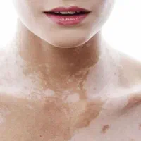 درمان انواع بیماریهای پوستی|آرایشی، بهداشتی، درمانی|شاهرود (اردبیل), |دیوار