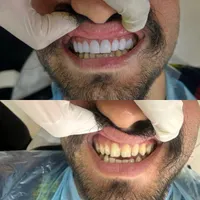 کامپوزیت دندان|خدمات آرایشگری و زیبایی|کرج, شهر جدید اندیشه|دیوار