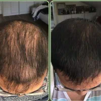 دیگه داری کچل میشی وقتشه زود تر اقدام کنی