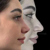عمل جراحی بینی فقط ۳۵ میلیون/لیفت صورت|خدمات زیبایی و سلامت|کرج, فاز ۲ مهرشهر|دیوار