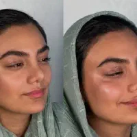 بوتاکس 800ژل اودری 600نخ لاغری وآنزیم1200 چربی