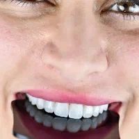 زیبایی لبخند کامپوزیت ایمپلنت ارتودنسی اقساط