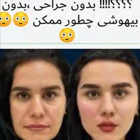 ژل لب روسی،بوتاکس بالیوودی، فیلرزیر چشم،لیفت شقیقه|خدمات آرایشگری و زیبایی|مشهد, سرافرازان|دیوار