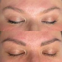 ریموو تتوی تک جلسه ای نتیجه قطعی