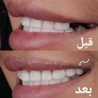 ایمپلنت دندان کاشت و روکش فوری اوردنچر از دم اقساط|خدمات آرایشگری و زیبایی|تهران, قیطریه|دیوار